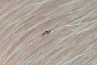 A close-up picture of a head louse in hair on the scalp.