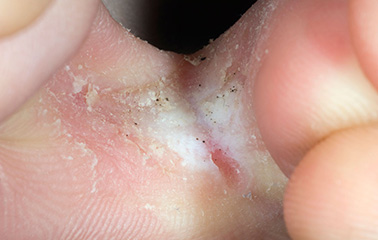 Confirm. And Deep itching bottom of feet gradually. think Was specially Deep itching bottom of feet can help