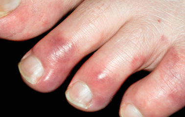 corn on toe nhs