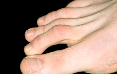Foot Problems And The Podiatrist Nhs Learn More